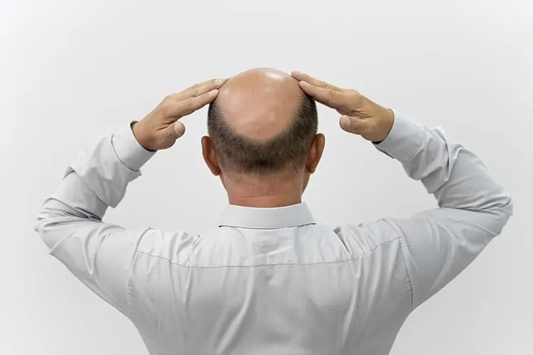 male baldness and heart disease