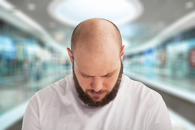 why do men go bald