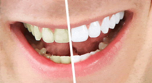 Natural Ways for a Brighter Smile