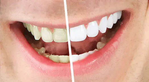 Natural Ways for a Brighter Smile
