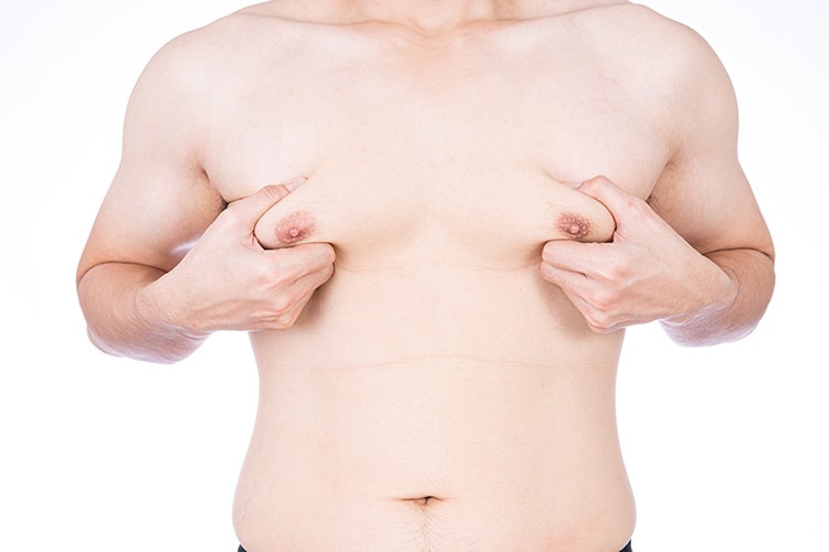 gynecomastia