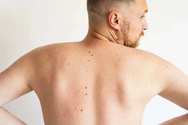 what causes back acne